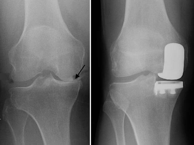 Total Vs. Partial Joint Replacement Surgery